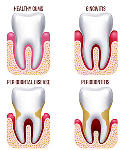 periodontitis