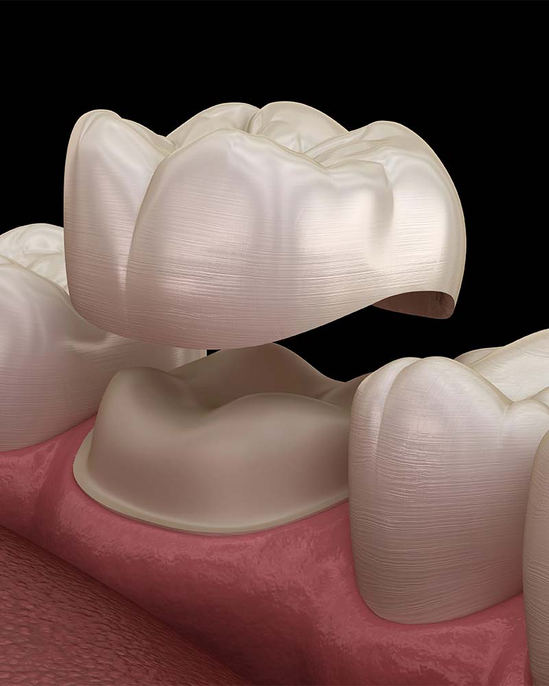 same-day dental crowns offered at Broadway Heights Dental